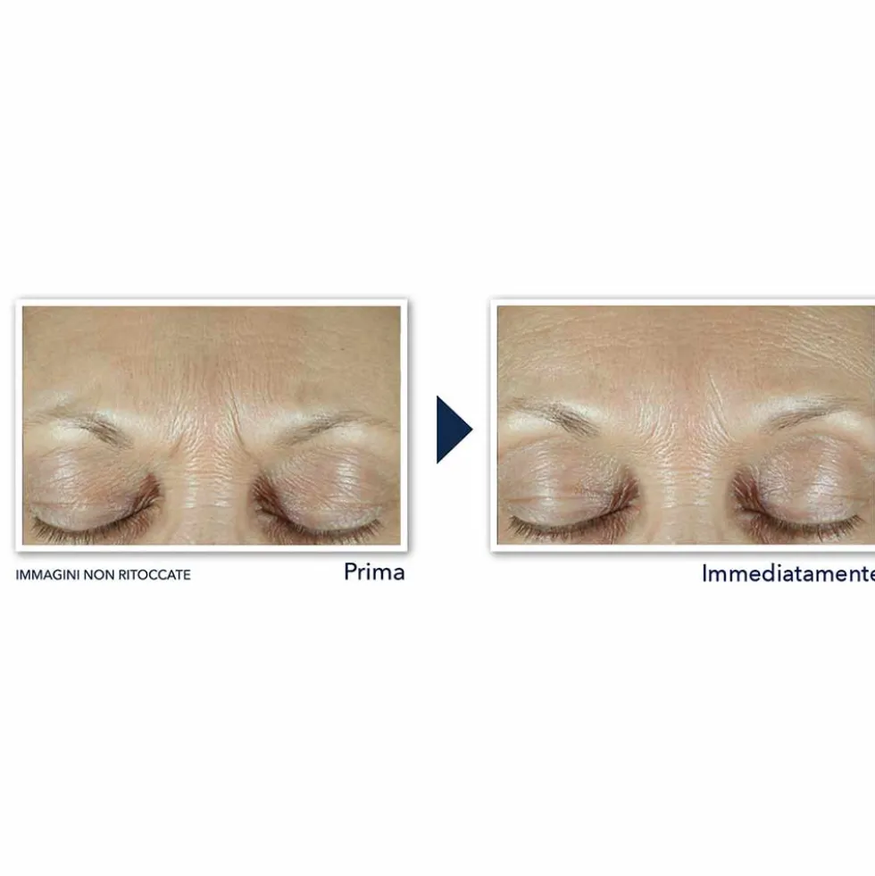 RoC Derm Correxion - Fill + Treat Siero Viso Retinolo e Acido Ialuronico, 15ml